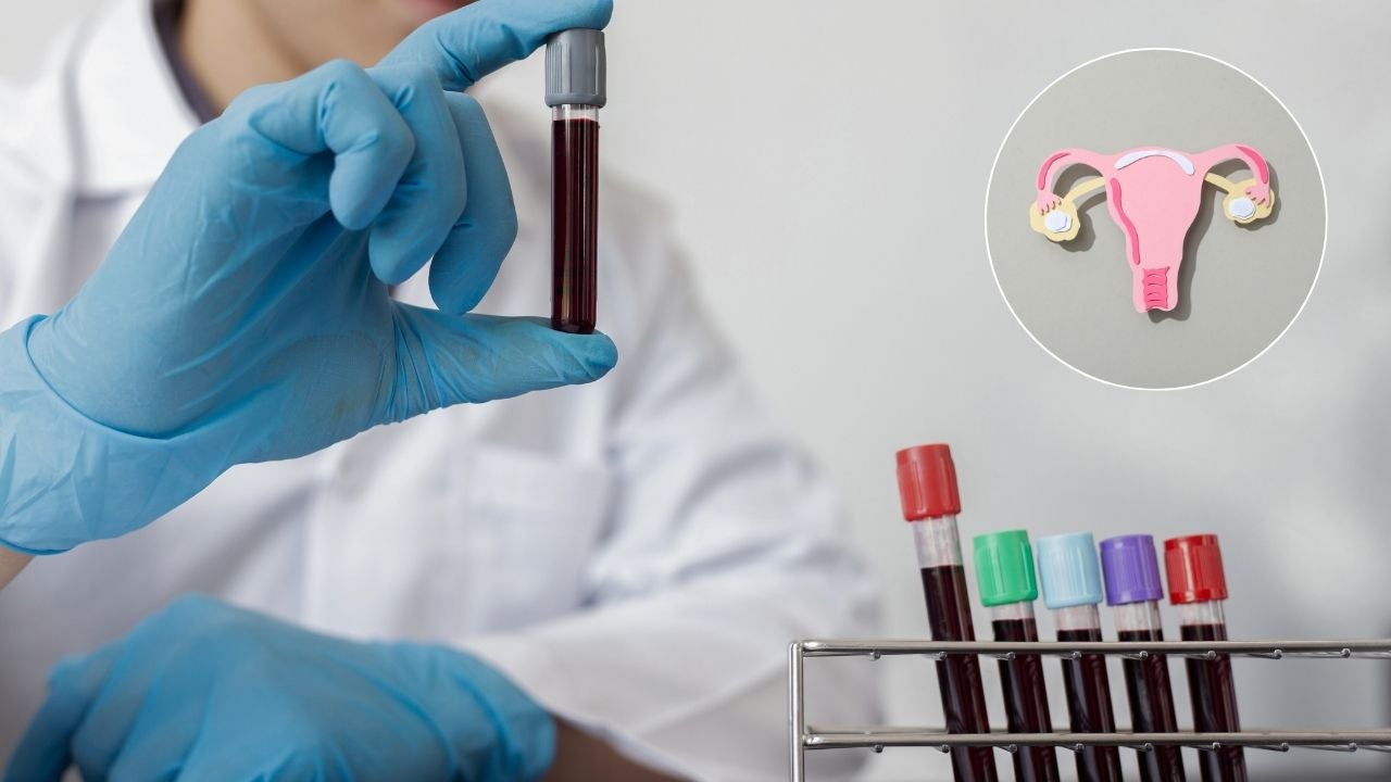 Un análisis de sangre permitiría detectar el cáncer de ovario en sus primeras etapas - fotos referencia: Canva Un análisis de sangre permitiría detectar el cáncer de ovario en sus primeras etapas - fotos referencia: Canva