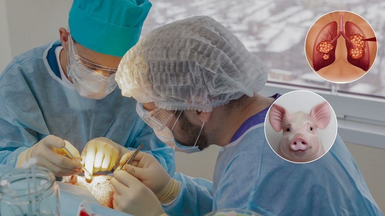 Así se llevó a cabo el primer trasplante de un pulmón de cerdo a un ser humano - Fotos referencia: Canva