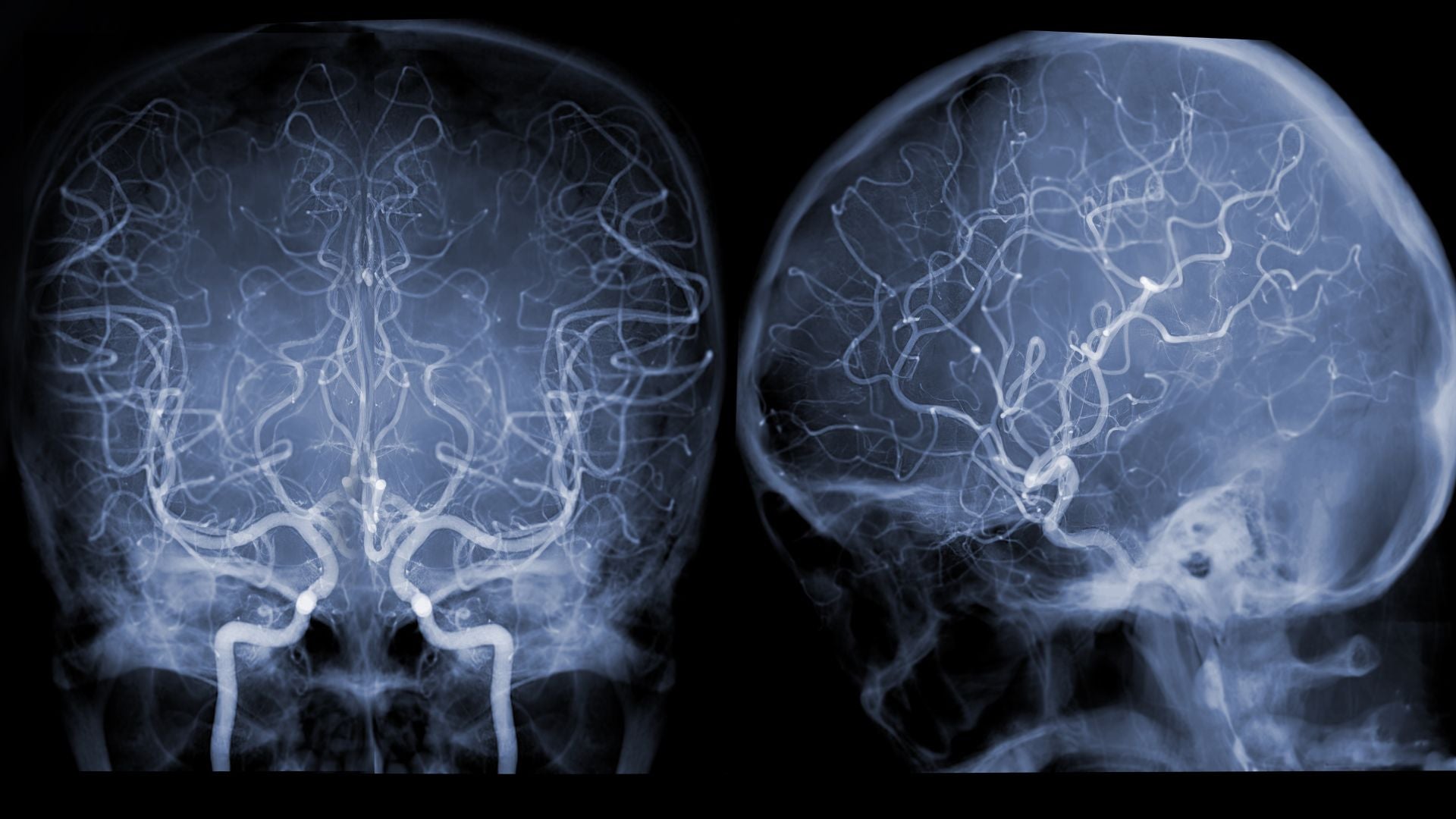 Glioma de tronco cerebral | Foto Canva