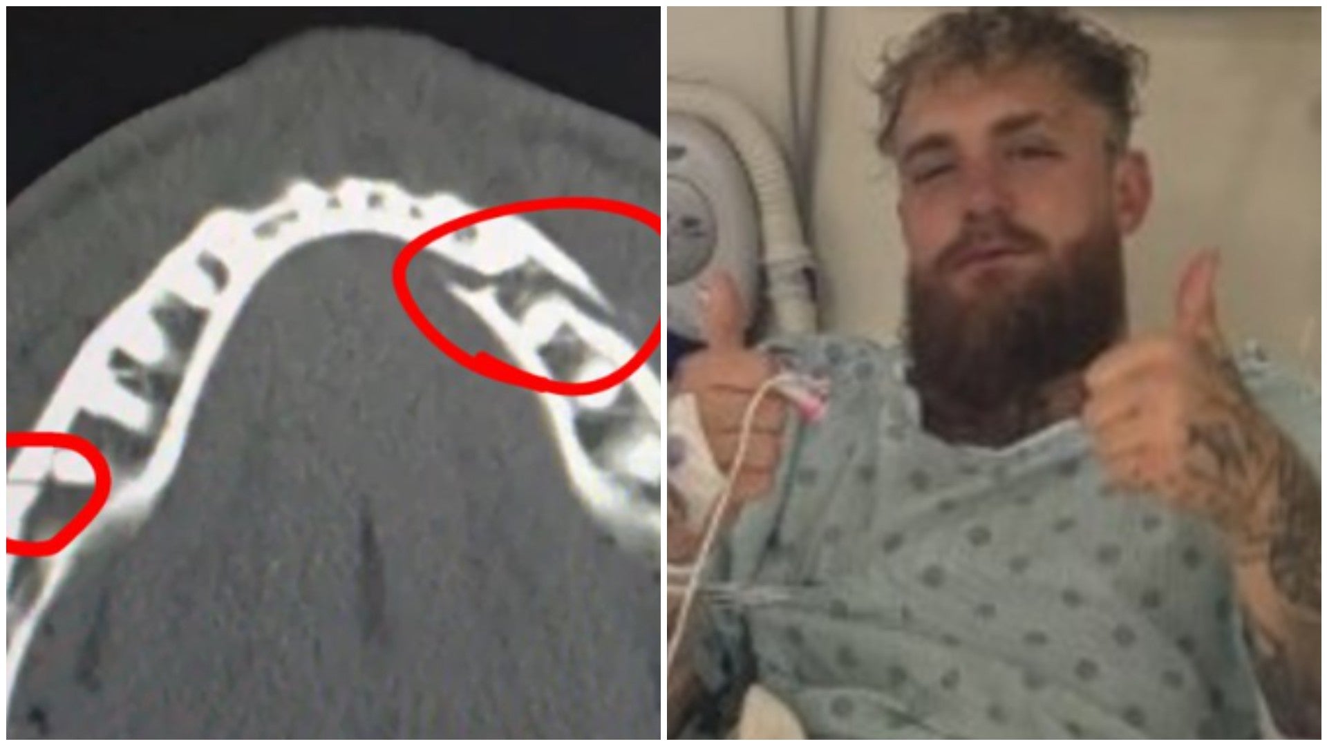 Radiografía de la mandíbula del youtuber Jake Paul - Fotos: Instagram @jakepaul
