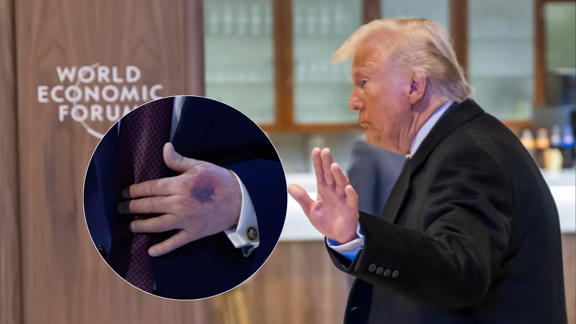 Donald Trump tiene moretones en la mano / FOTO: EFE