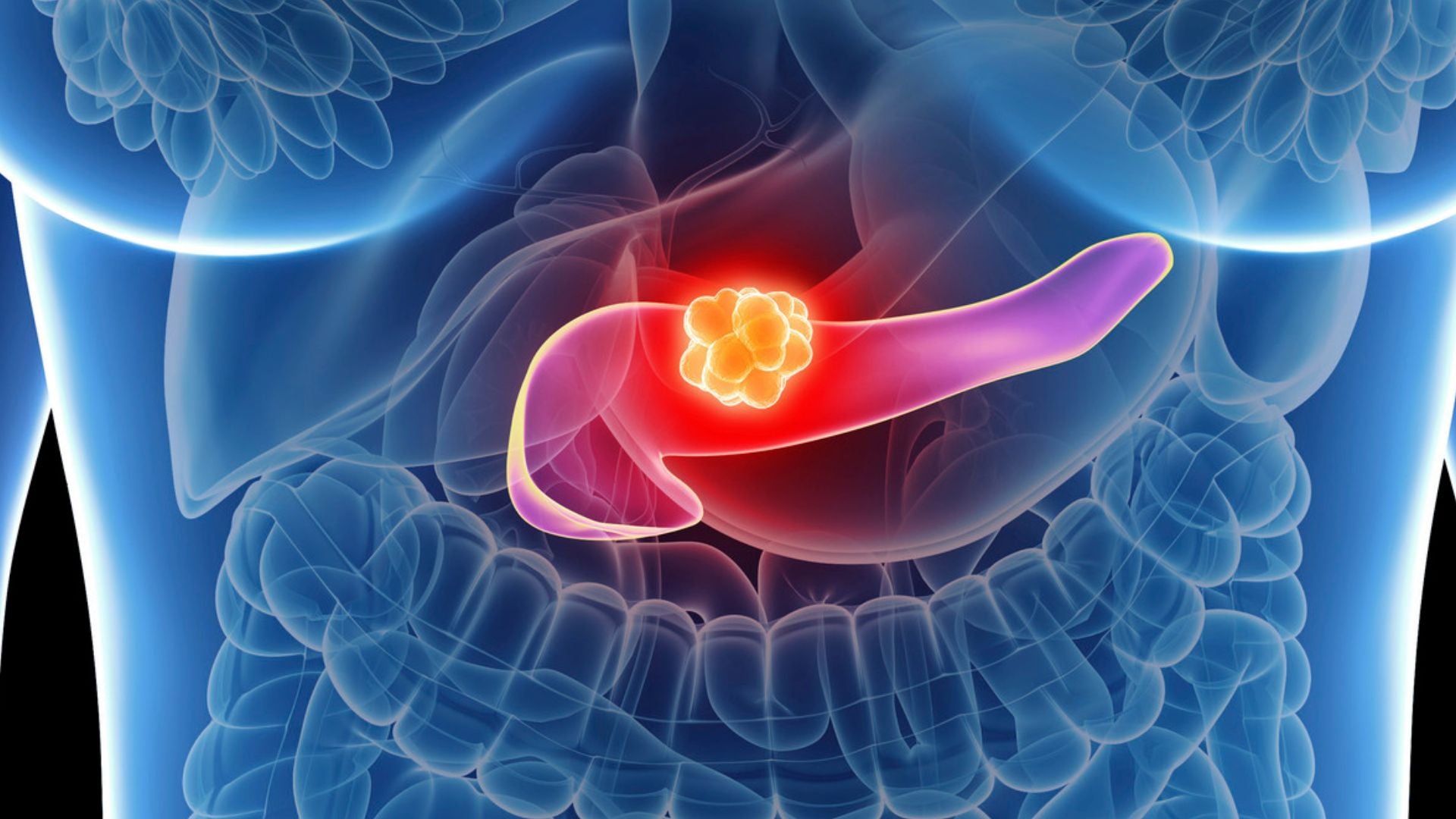 Cáncer de páncreas | Foto Canva