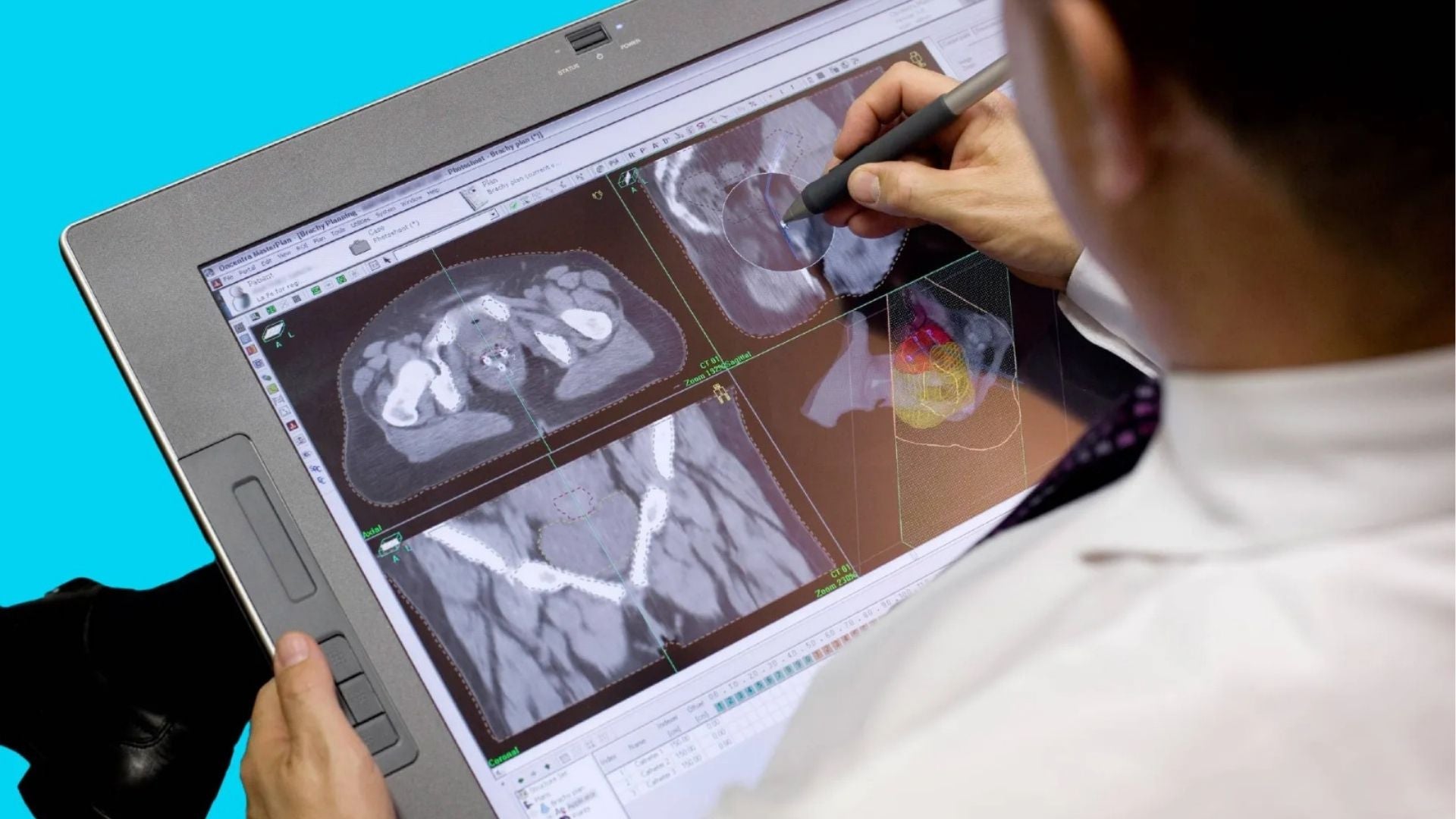 Braquiterapia - Foto Instituto Nacional de Cancerología