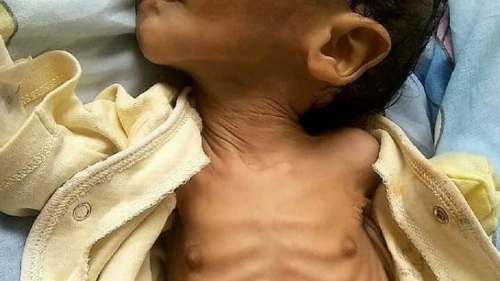 desnutrición-Venezuela